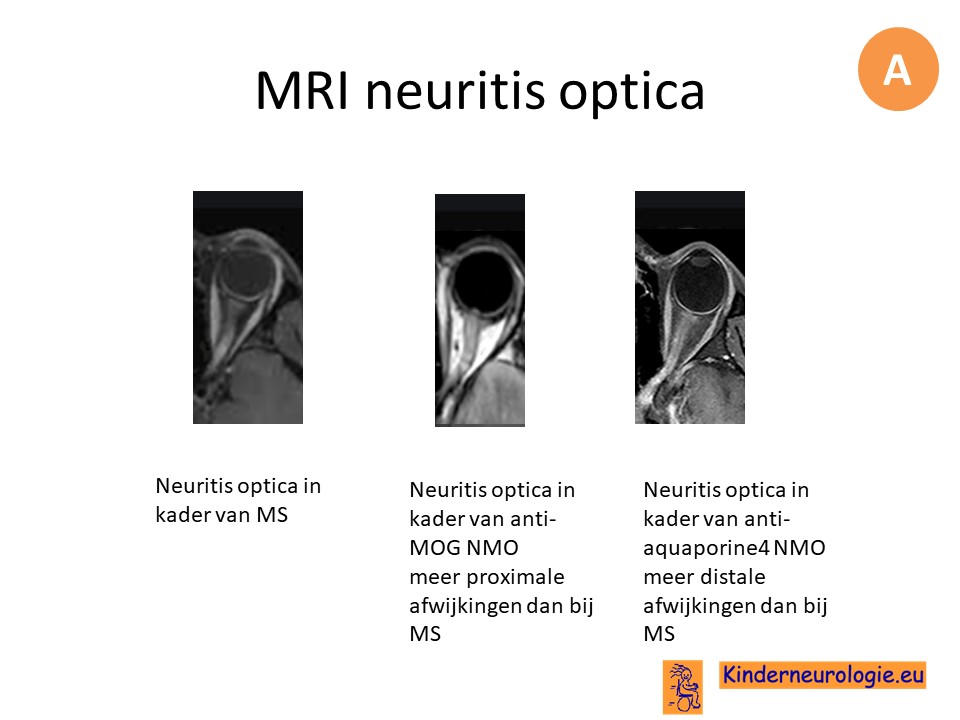 mri neuritis optica